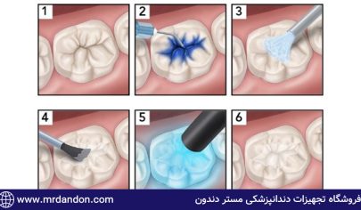 سیلر دندانپزشکی-مستردندون